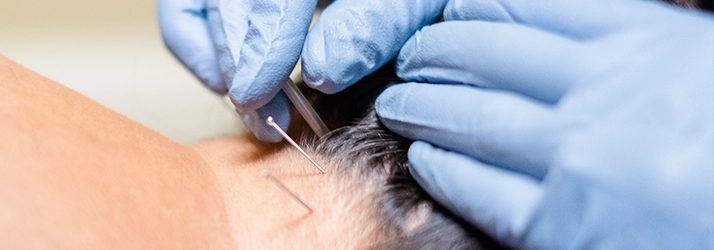 Chiropractic Glasgow KY Woman Getting Dry Needle Treatment Chiropractic Glasgow KY Woman Getting Dry Needle Treatment